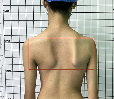 Đánh giá toàn diện chứng vẹo cột sống: Hiểu, xác định và giải quyết vấn đề sức khỏe cột sống