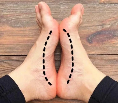 Đánh giá vòm bàn chân cao: Phương pháp lâm sàng, đánh giá chỉ số vòm và ứng dụng thương mại trong...