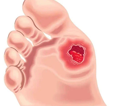 Đánh giá bàn chân đái tháo đường: Hiểu biết lâm sàng, quản lý rủi ro và cơ hội thương mại