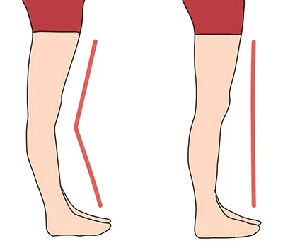 Đánh giá và chỉnh sửa genu recurvatum: Hướng dẫn lâm sàng và thương mại cho thực hành hiện đại