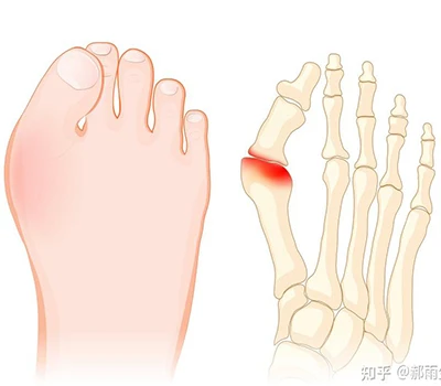 Hallux Valgus: Hướng dẫn khoa học hoàn chỉnh