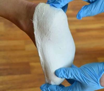 Máy quét bàn chân 3D sẽ biến đổi tương lai của các thiết bị hỗ trợ chỉnh hình như thế nào?