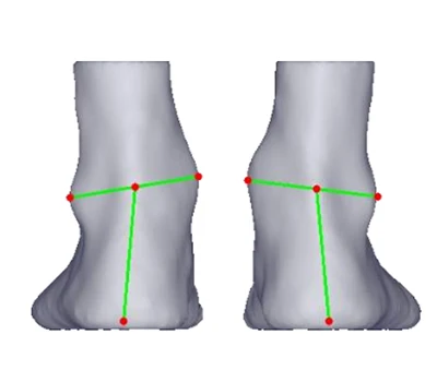 Gót chân Valgus và Varus: một mối đe dọa thầm lặng