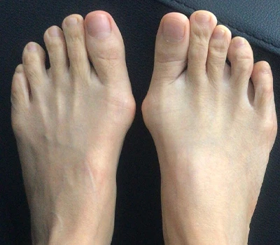 Đo lường Hallux Valgus: Tại sao máy quét 3D vượt xa các bác sĩ lâm sàng và bệnh viện
