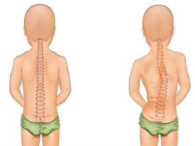 Phương pháp sàng lọc vẹo cột sống mới: Cột sống kỹ thuật số AI & 3D