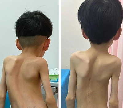 Sức khỏe cột sống: Vai trò của công nghệ quét cơ thể 3D trong đánh giá chứng vẹo cột sống và chuy...