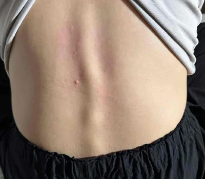 Phân tích toàn diện Vẹo cột sống: Tìm hiểu thực trạng và đổi mới công nghệ trong đánh giá và quản lý