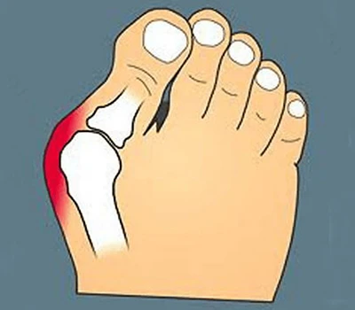Chuyển đổi dịch vụ chăm sóc Bunion: Tích hợp tính năng quét chính xác để nâng cao khả năng tùy ch...